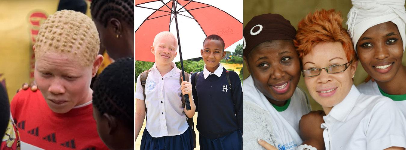 3 photos. One shows a young person with albinism in a crowd of darker skinned people. One shows two smiling children under an umbrella - one has albinism and the other has dark skin. the third photo is of three adult women, one of whom has albinism.